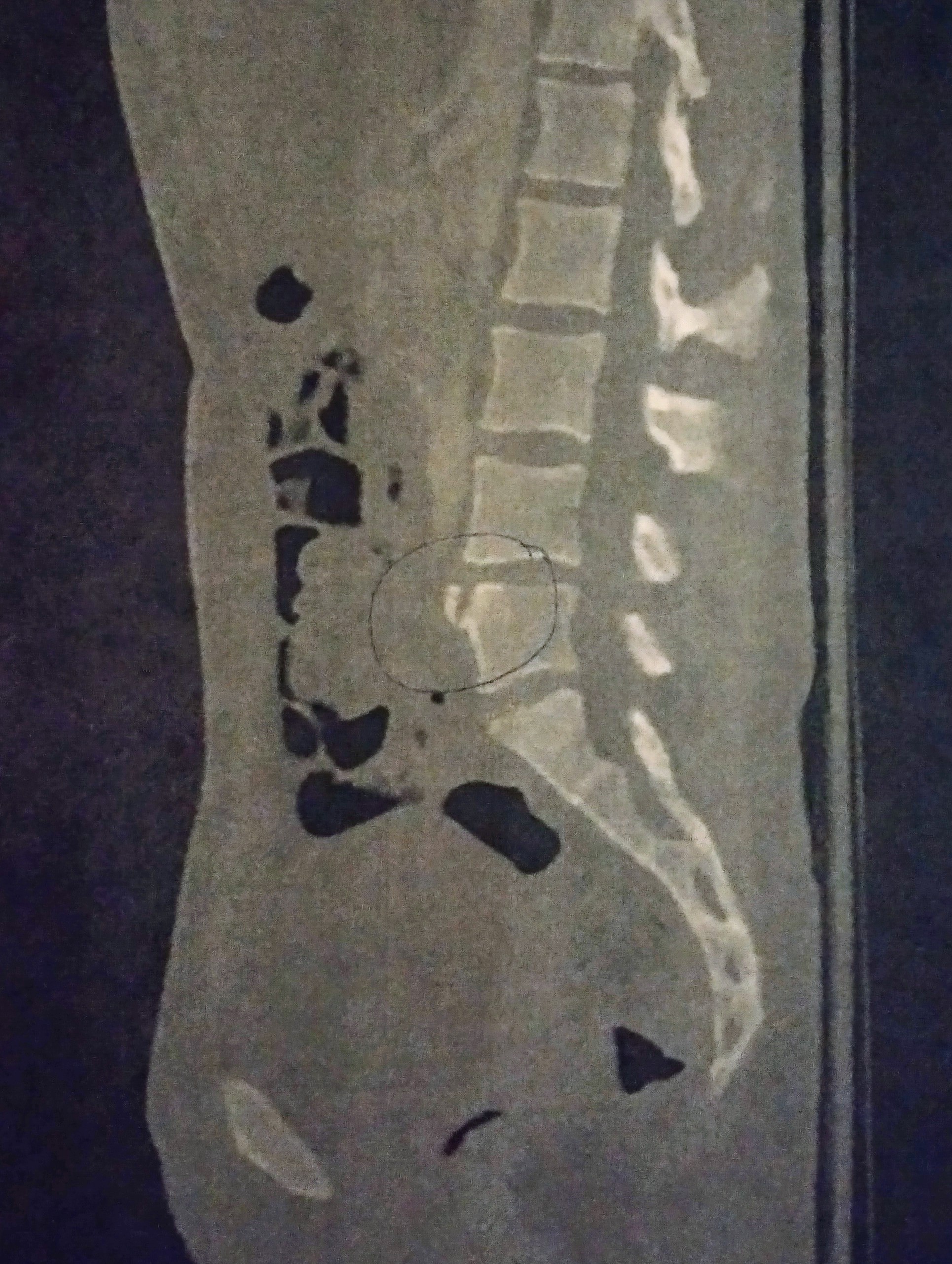 A side view of a CT scan showing the lumbar spine, highlighting a specific area of interest.